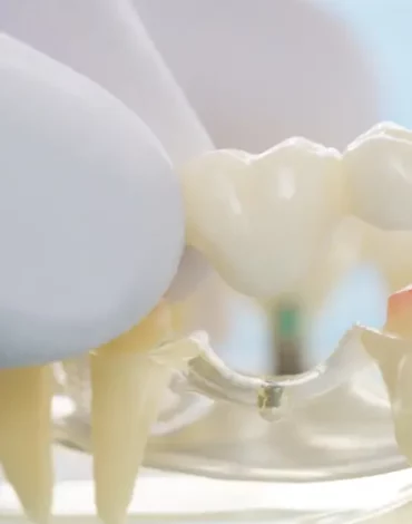 Dental Crowns & Bridges