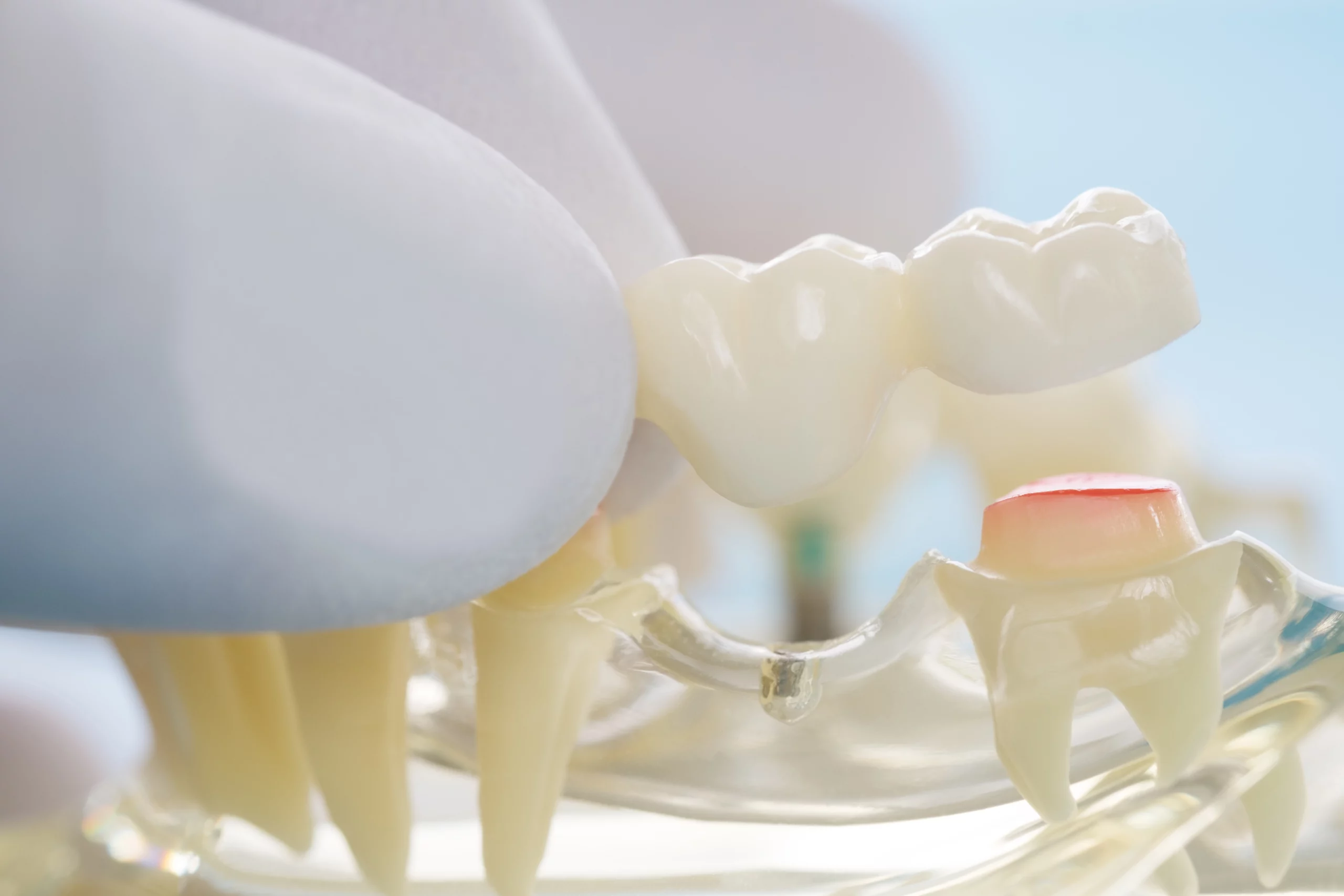 dental crowns and bridge