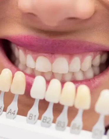 Porcelain Veneers